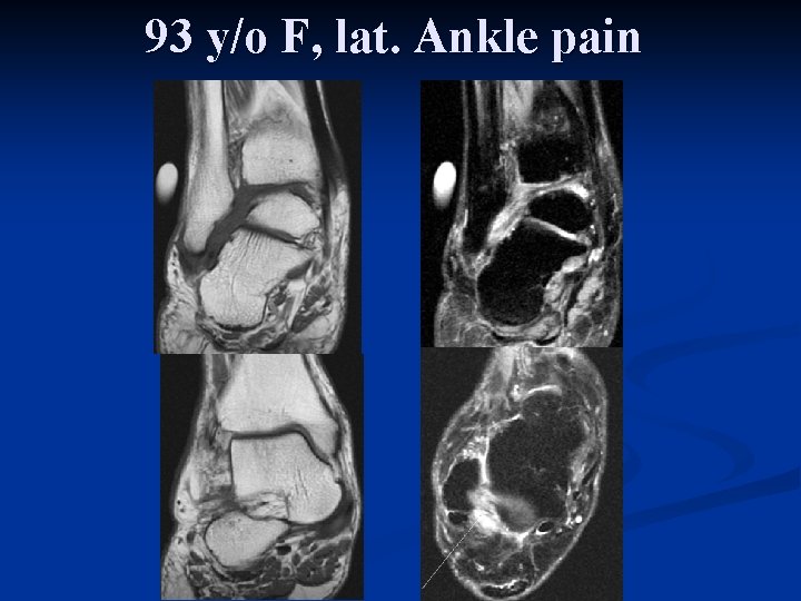 93 y/o F, lat. Ankle pain 