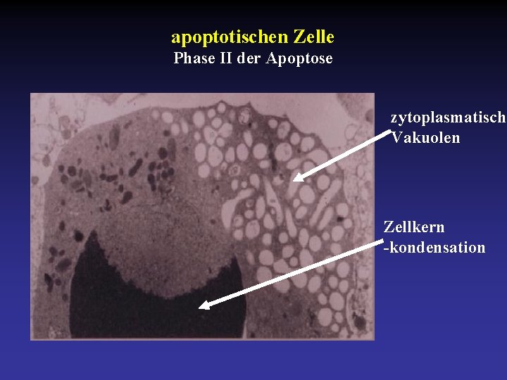 apoptotischen Zelle Phase II der Apoptose zytoplasmatische Vakuolen Zellkern -kondensation 