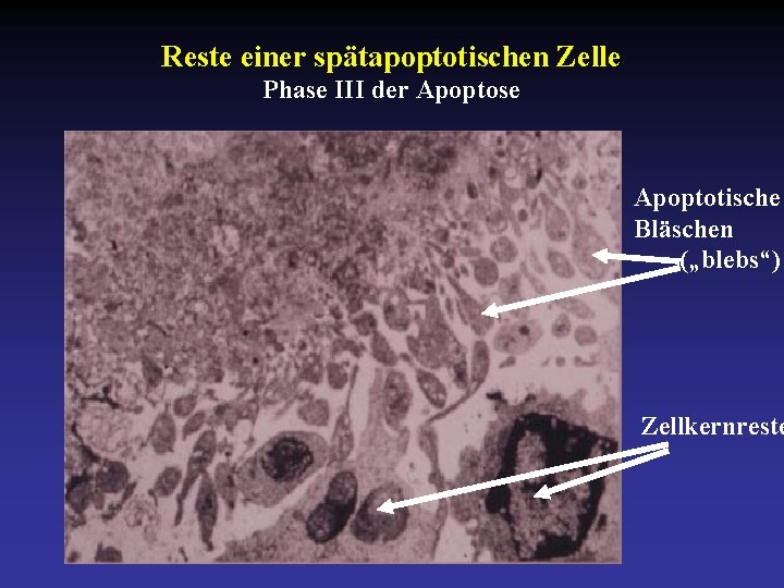 Reste einer spätapoptotischen Zelle Phase III der Apoptose Apoptotische Bläschen („blebs“) Zellkernreste 