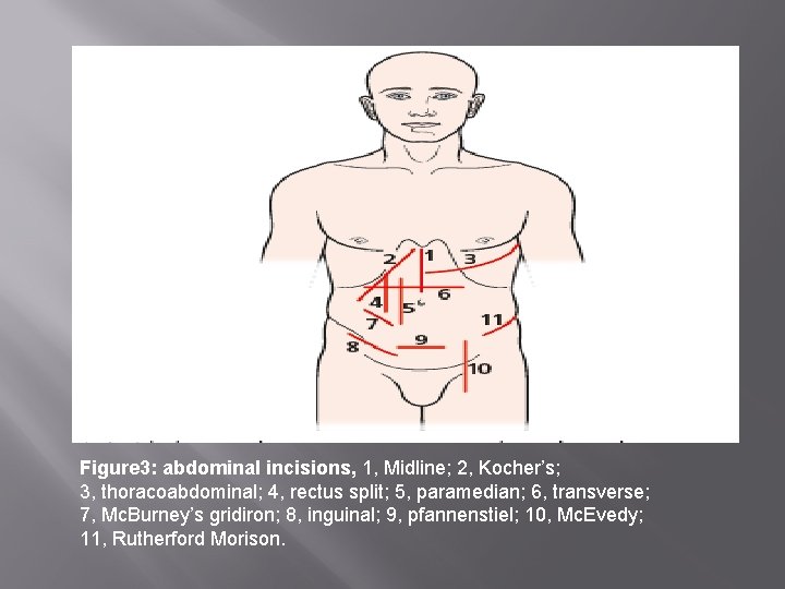 Figure 3: abdominal incisions, 1, Midline; 2, Kocher’s; 3, thoracoabdominal; 4, rectus split; 5,