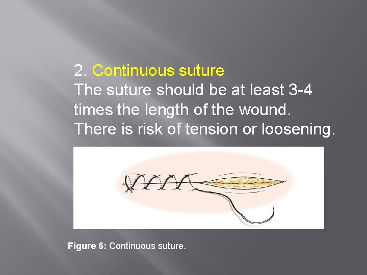 2. Continuous suture The suture should be at least 3 -4 times the length