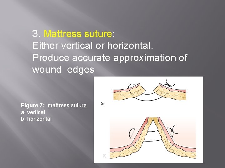 3. Mattress suture: Either vertical or horizontal. Produce accurate approximation of wound edges Figure