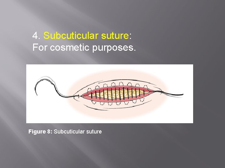 4. Subcuticular suture: For cosmetic purposes. Figure 8: Subcuticular suture 