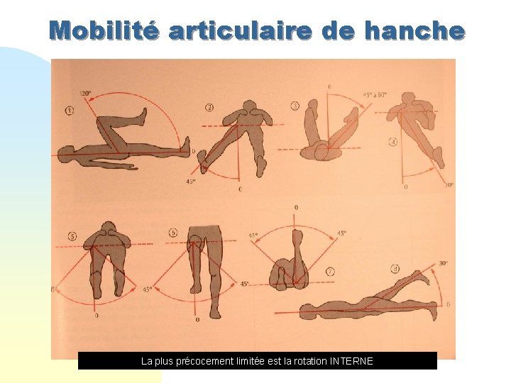 Mobilité articulaire de hanche La plus précocement limitée est la rotation INTERNE 