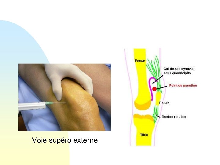 Voie supéro externe 