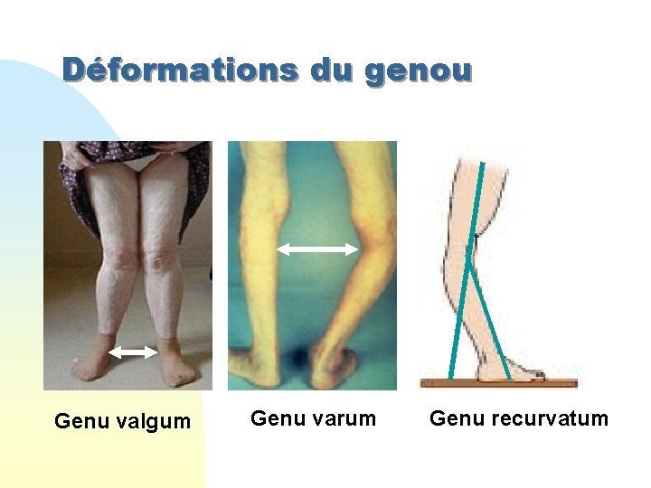 Déformations du genou Genu valgum Genu varum Genu recurvatum 