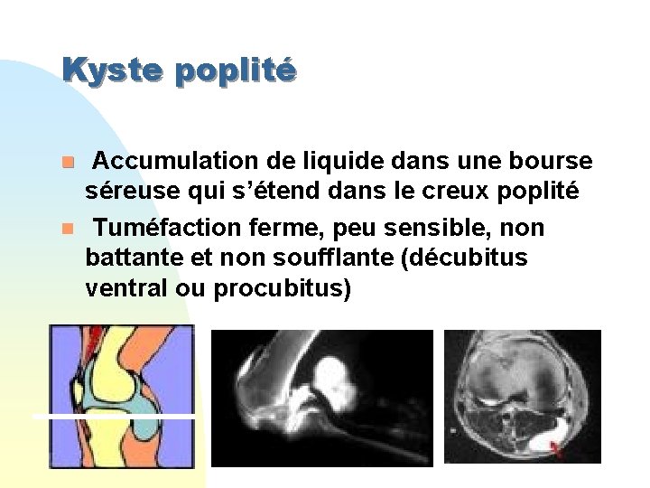 Kyste poplité n n Accumulation de liquide dans une bourse séreuse qui s’étend dans