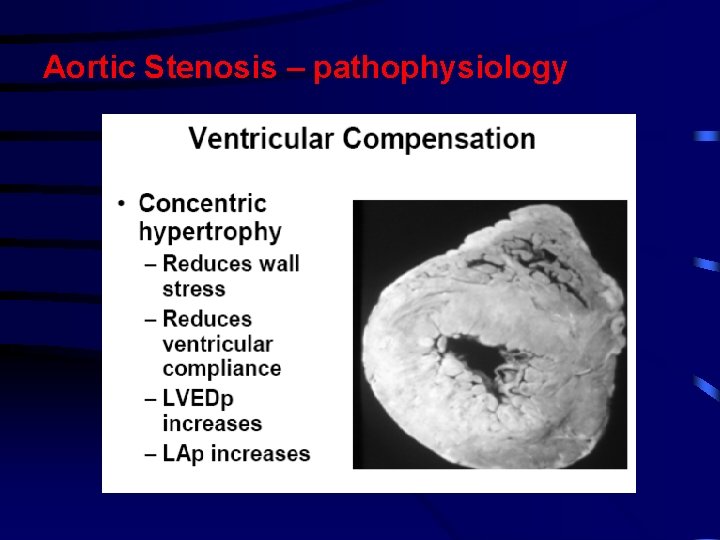Aortic Stenosis – pathophysiology Aortic Stenosis – pathophysiology
