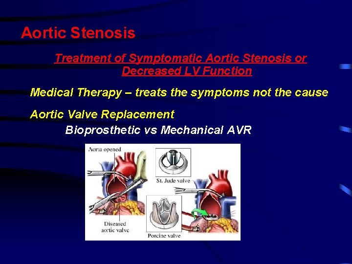 Aortic Stenosis Treatment of Symptomatic Aortic Stenosis or Decreased LV Function Medical Therapy – Aortic Stenosis Treatment of Symptomatic Aortic Stenosis or Decreased LV Function Medical Therapy –