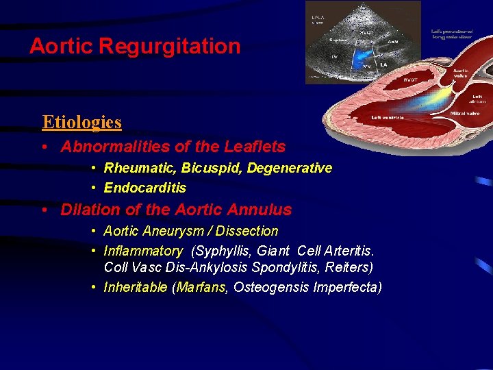 Aortic Regurgitation Etiologies • Abnormalities of the Leaflets • Rheumatic, Bicuspid, Degenerative • Endocarditis