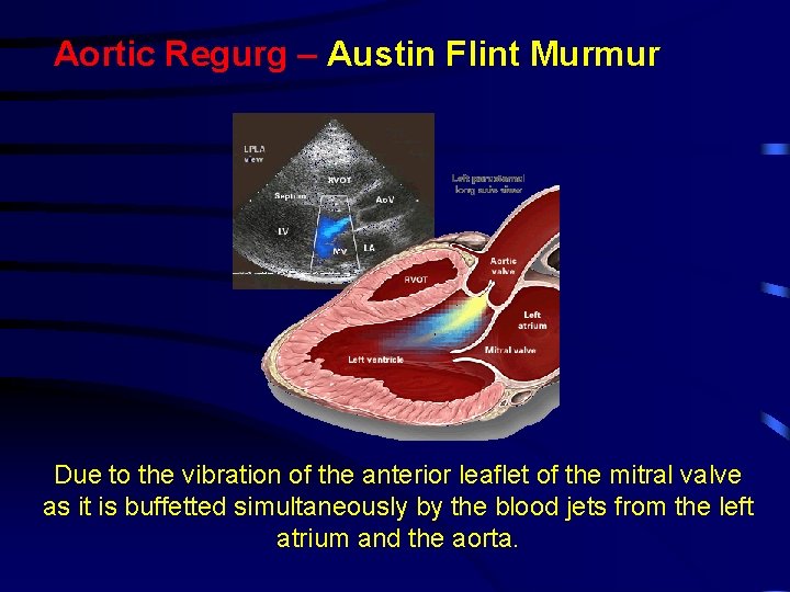 Aortic Regurg – Austin Flint Murmur Due to the vibration of the anterior leaflet Aortic Regurg – Austin Flint Murmur Due to the vibration of the anterior leaflet