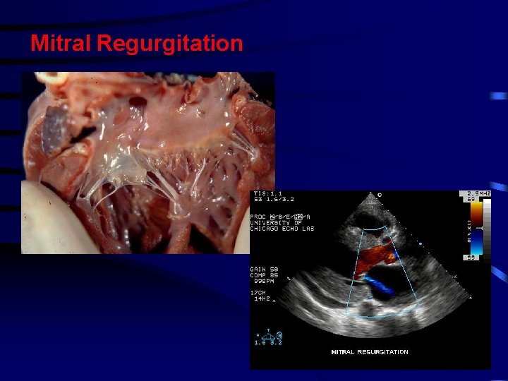 Mitral Regurgitation 