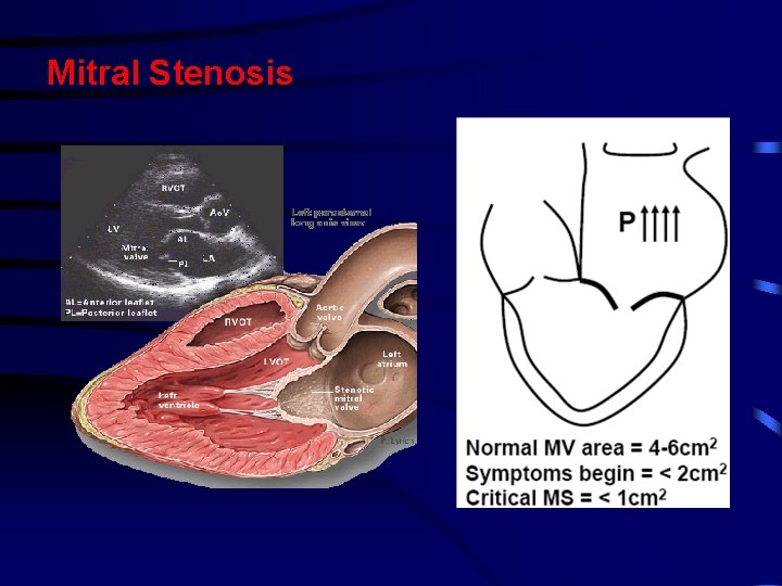 Mitral Stenosis Mitral Stenosis