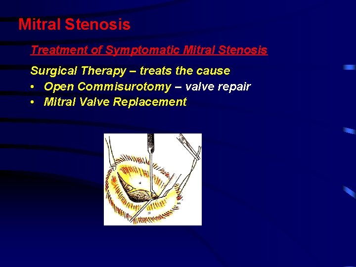 Mitral Stenosis Treatment of Symptomatic Mitral Stenosis Surgical Therapy – treats the cause •