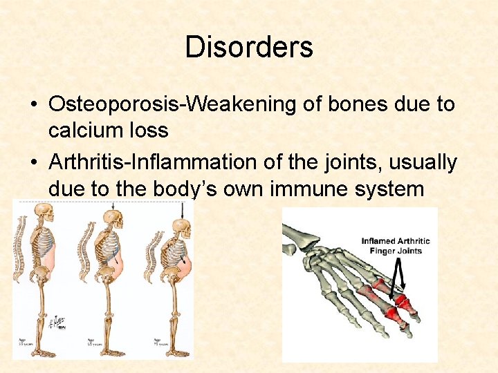 Disorders • Osteoporosis-Weakening of bones due to calcium loss • Arthritis-Inflammation of the joints,