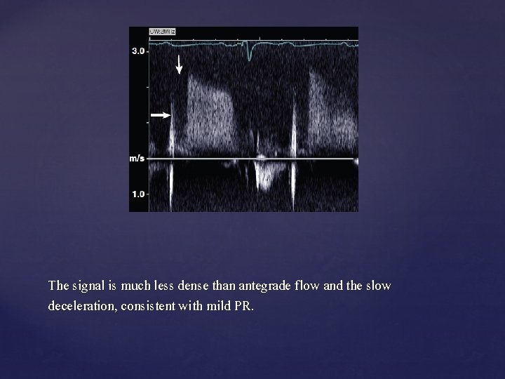 The signal is much less dense than antegrade flow and the slow deceleration, consistent