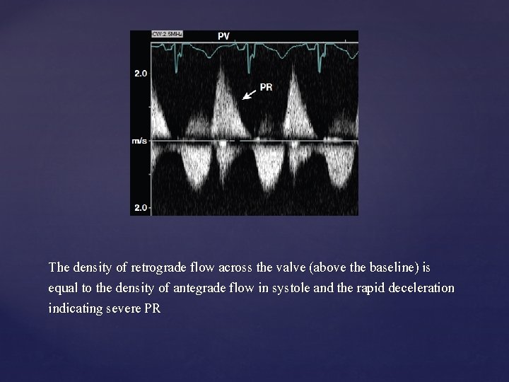 The density of retrograde flow across the valve (above the baseline) is equal to