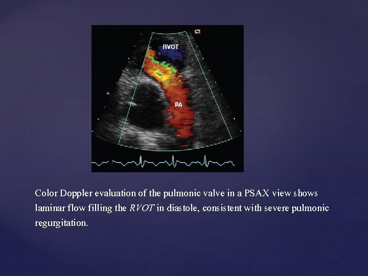 Color Doppler evaluation of the pulmonic valve in a PSAX view shows laminar flow