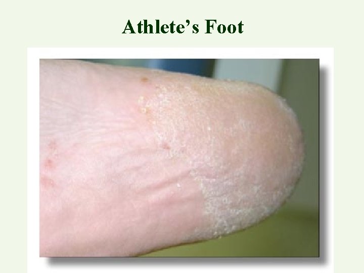 Athlete’s Foot 