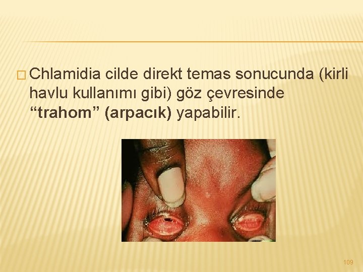 � Chlamidia cilde direkt temas sonucunda (kirli havlu kullanımı gibi) göz çevresinde “trahom” (arpacık)