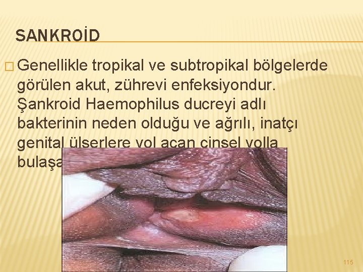 SANKROİD � Genellikle tropikal ve subtropikal bölgelerde görülen akut, zührevi enfeksiyondur. Şankroid Haemophilus ducreyi