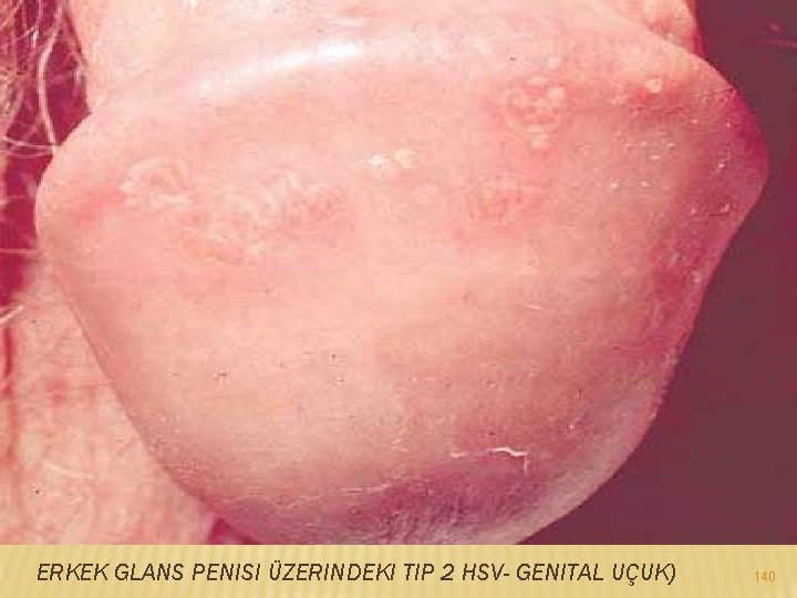 ERKEK GLANS PENISI ÜZERINDEKI TIP 2 HSV- GENITAL UÇUK) 140 