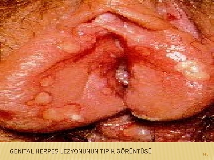 GENITAL HERPES LEZYONUNUN TIPIK GÖRÜNTÜSÜ 145 