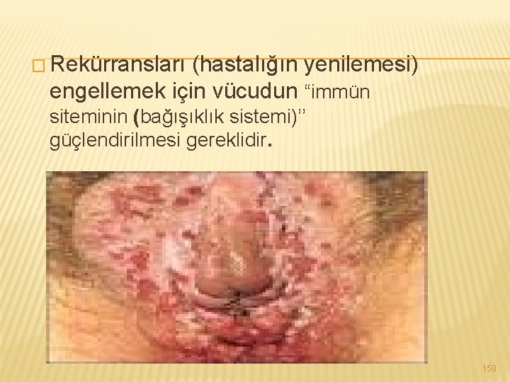 � Rekürransları (hastalığın yenilemesi) engellemek için vücudun “immün siteminin (bağışıklık sistemi)’’ güçlendirilmesi gereklidir. 150