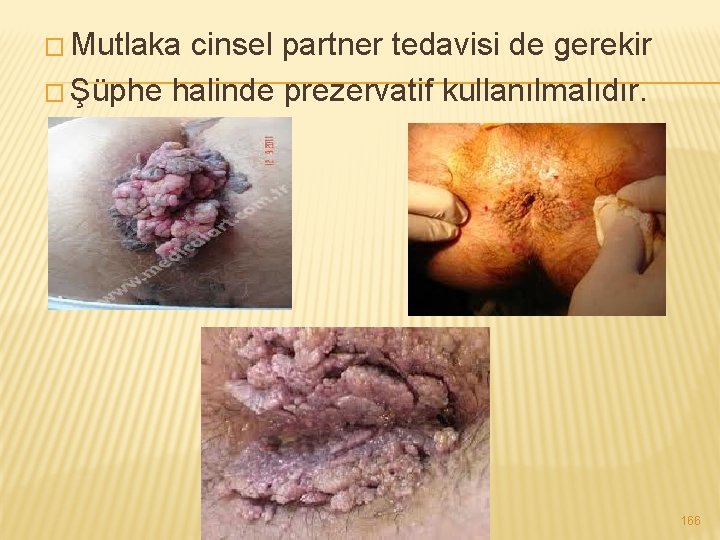 � Mutlaka cinsel partner tedavisi de gerekir � Şüphe halinde prezervatif kullanılmalıdır. 166 