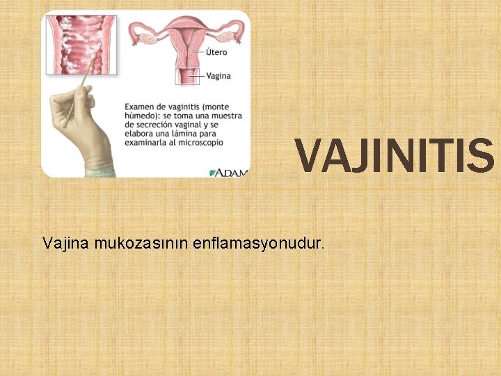 VAJINITIS Vajina mukozasının enflamasyonudur. 