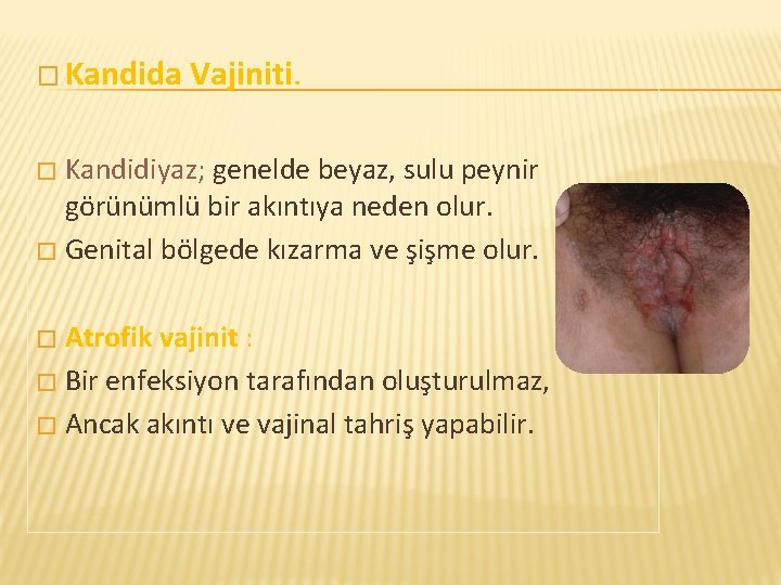 � Kandida Vajiniti. Kandidiyaz; genelde beyaz, sulu peynir görünümlü bir akıntıya neden olur. �