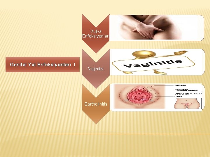 Vulva Enfeksiyonları Genital Yol Enfeksiyonları I Vajinitis Bartholinitis 