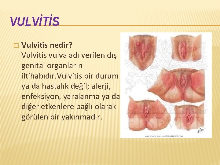 VULVİTİS � Vulvitis nedir? Vulvitis vulva adı verilen dış genital organların iltihabıdır. Vulvitis bir