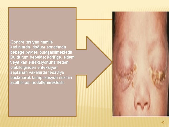 Gonore taşıyan hamile kadınlarda, doğum esnasında bebeğe bakteri bulaşabilmektedir. Bu durum bebekte; körlüğe, eklem