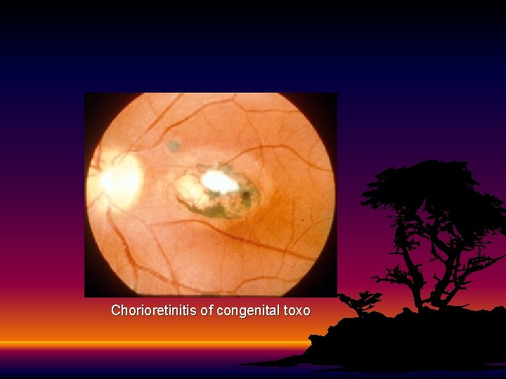 Chorioretinitis of congenital toxo 