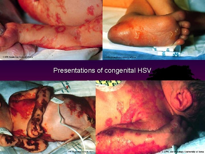 Presentations of congenital HSV 