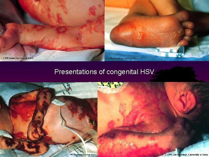 Presentations of congenital HSV 