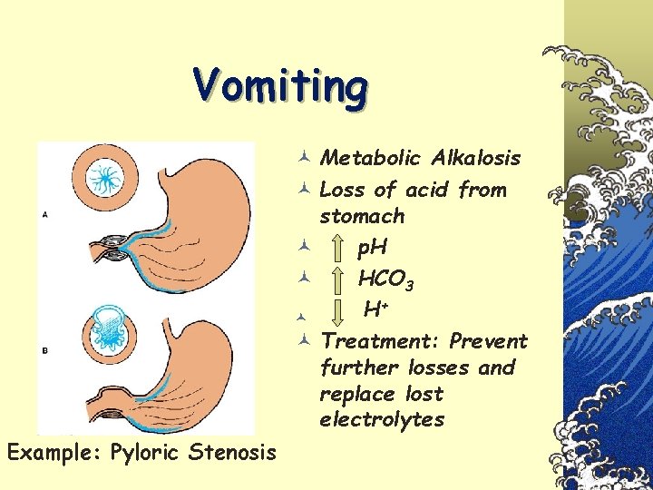 Vomiting © Metabolic Alkalosis © Loss of acid from stomach © p. H ©