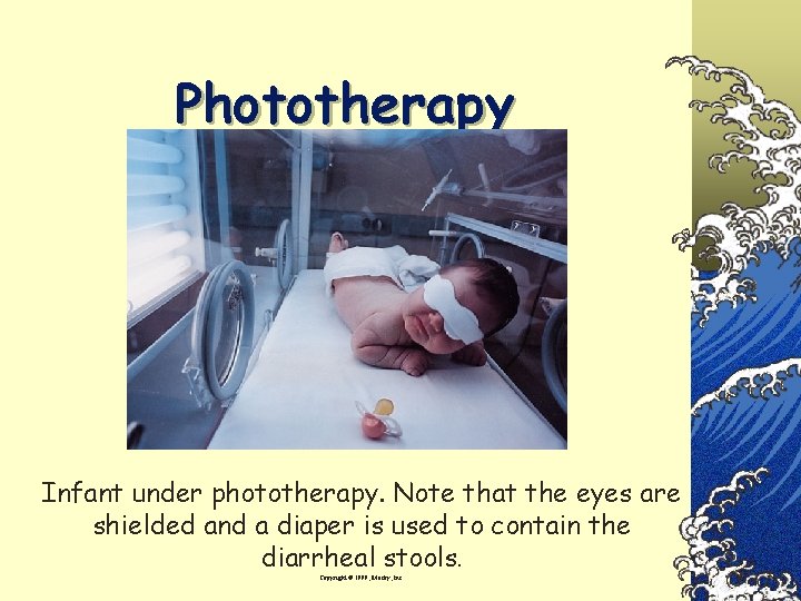  Phototherapy Infant under phototherapy. Note that the eyes are shielded and a diaper