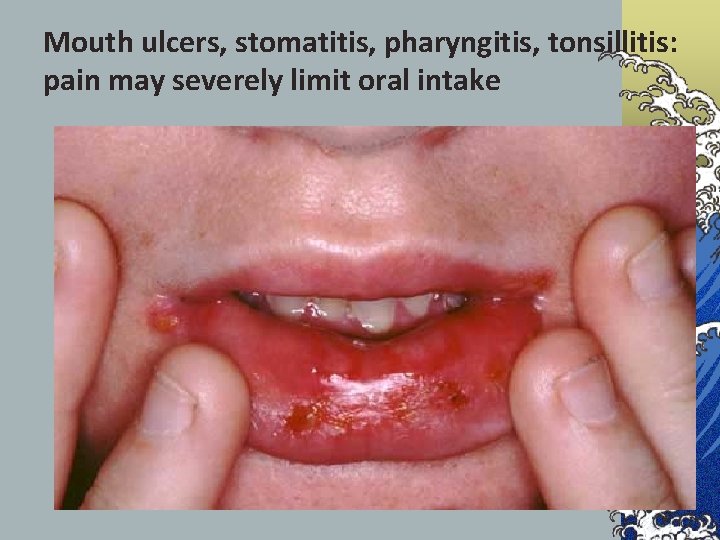 Mouth ulcers, stomatitis, pharyngitis, tonsillitis: pain may severely limit oral intake 