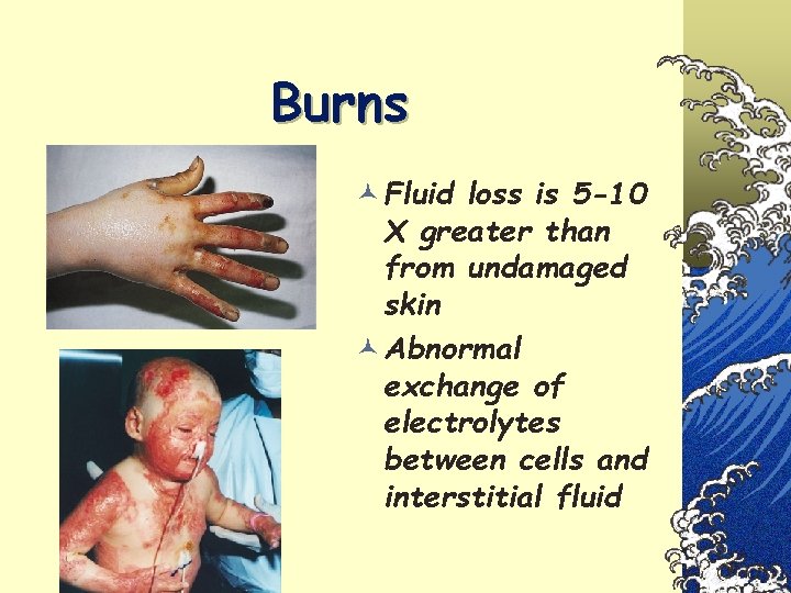 Burns © Fluid loss is 5 -10 X greater than from undamaged skin ©