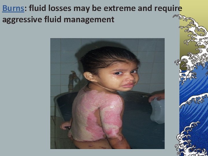 Burns: fluid losses may be extreme and require aggressive fluid management 