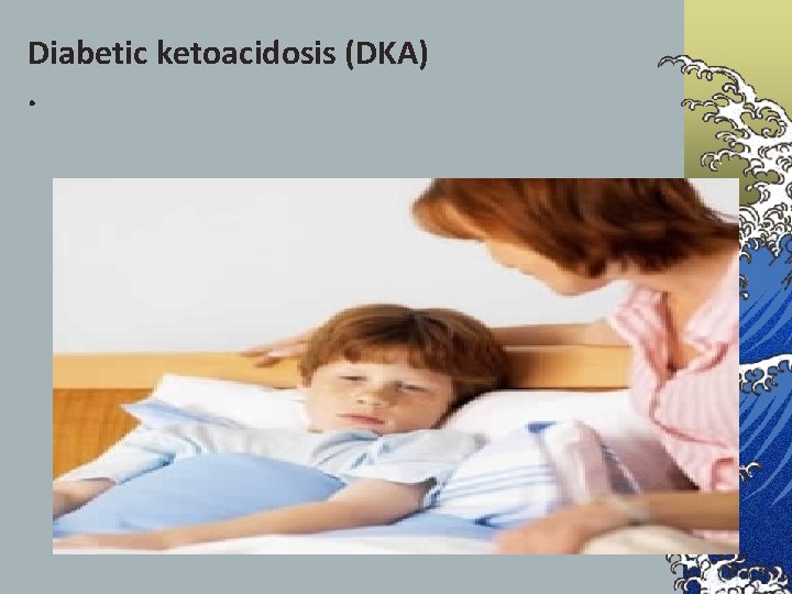 Diabetic ketoacidosis (DKA). 