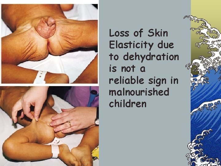 Loss of Skin Elasticity due to dehydration is not a reliable sign in malnourished
