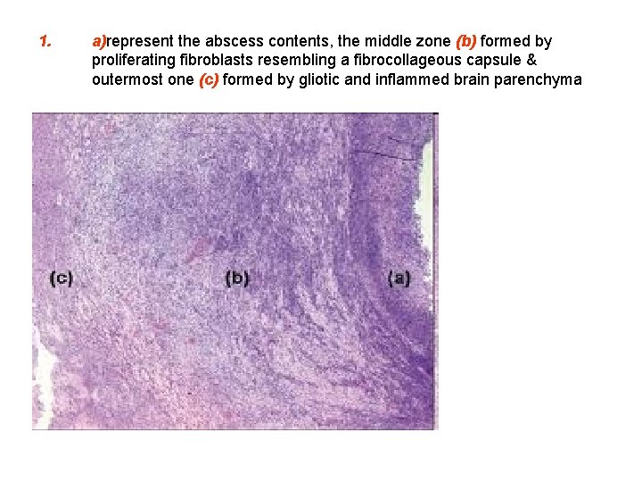 1. a)represent the abscess contents, the middle zone (b) formed by proliferating fibroblasts resembling