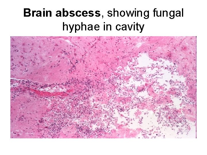 Brain abscess, showing fungal hyphae in cavity 