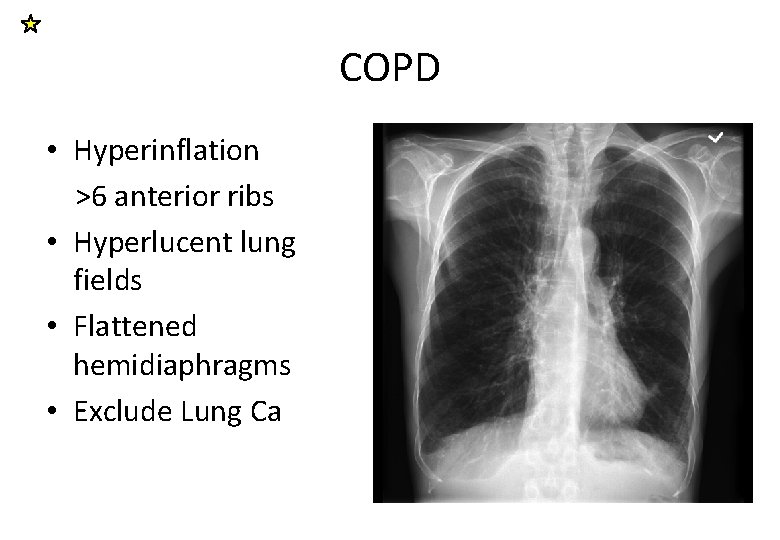 COPD • Hyperinflation >6 anterior ribs • Hyperlucent lung fields • Flattened hemidiaphragms •