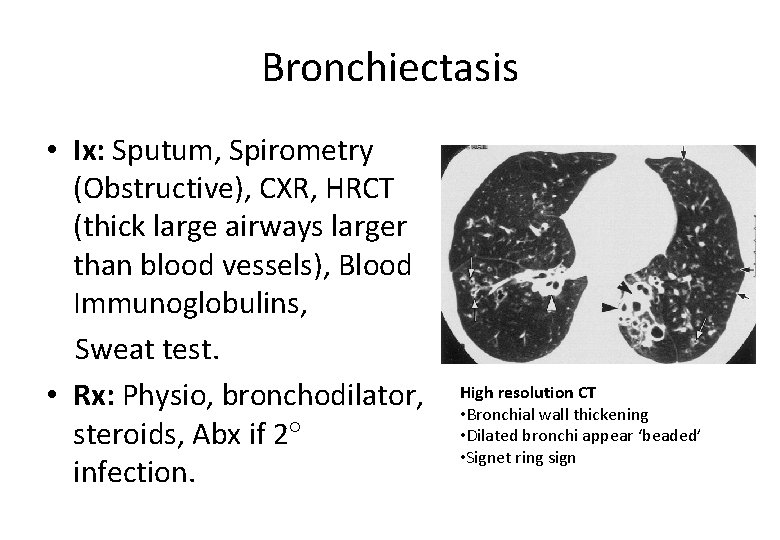 Bronchiectasis • Ix: Sputum, Spirometry (Obstructive), CXR, HRCT (thick large airways larger than blood