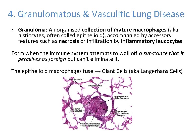 4. Granulomatous & Vasculitic Lung Disease • Granuloma: An organised collection of mature macrophages