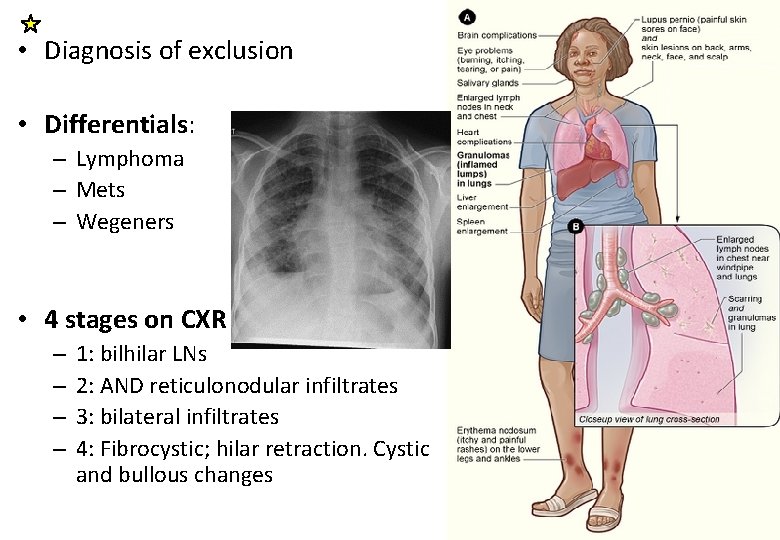  • Diagnosis of exclusion • Differentials: – Lymphoma – Mets – Wegeners •